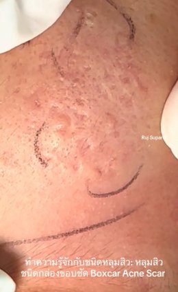 ทำความรู้จักชนิดหลุมสิว: Rolling, Boxcar และ Ice Pick Acne Scar