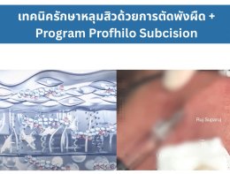 เทคนิครักษาหลุมสิว ด้วยการตัดพังผืดหลุมสิวเทคนิค Program Profhilo Bio-Remodeling Fanning Subcision Techniques for Acne Scar Treatment