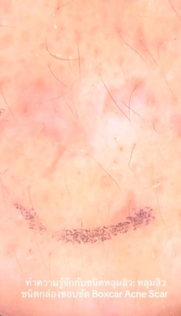 ทำความรู้จักชนิดหลุมสิว: Rolling, Boxcar และ Ice Pick Acne Scar