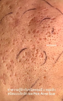 ทำความรู้จักชนิดหลุมสิว: Rolling, Boxcar และ Ice Pick Acne Scar