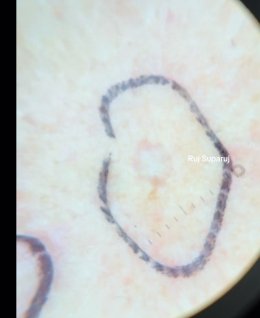 "แผลเป็นหลุมอีสุกอีใส" (Chicken Pox Scars) ลักษณะเฉพาะและการรักษา ?