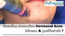 สิวฮอร์โมน สิวรอบเดือน Hormonal Acne มีลักษณะ & ดูแลได้อย่างไร ?
