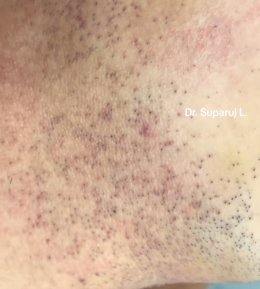 ขนคุดชนิดที่มีรอยแดง Keratosis Pilaris Rubra = KP Rubra มีลักษณะอย่างไร & ดูแลได้อย่างไร ?