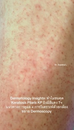 "ทำไมขนคุด Keratosis Pilaris (KP) ถึงมีสีแดง? + แนวทางการดูแล + วิเคราะห์ผิวกล้องส่องขยาย Dermoscopy " วันนี้หมอจะพามาวิเคราะห์ด้วยกล้องขยายผิวหนังหรือ Dermoscopy กันครับ