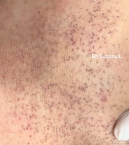 ขนคุดชนิดที่มีรอยแดง Keratosis Pilaris Rubra = KP Rubra มีลักษณะอย่างไร & ดูแลได้อย่างไร ?