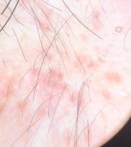 ขนคุดชนิดที่มีรอยแดง Keratosis Pilaris Rubra = KP Rubra มีลักษณะอย่างไร & ดูแลได้อย่างไร ?