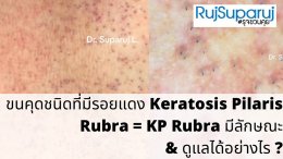 ขนคุดชนิดที่มีรอยแดง Keratosis Pilaris Rubra = KP Rubra มีลักษณะอย่างไร & ดูแลได้อย่างไร ?