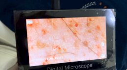 รักษาหลุมสิว แต่ไม่สะดวกมารับการรักษาทุกเดือน จะรักษาได้ผลหรือไม่ ? 