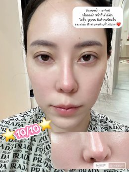 ขอบคุณคุณจูน @jirasuri มากนะครับที่ไว้วางใจให้หมอได้ดูแลปัญหาเรื่องรูขุมขนและจุดด่างดำด้วย โปรแกรม LaserME ครับผม