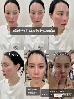 ขอบคุณคุณจูน @jirasuri มากนะครับที่ไว้วางใจให้หมอได้ดูแลปัญหาเรื่องรูขุมขนและจุดด่างดำด้วย โปรแกรม LaserME ครับผม