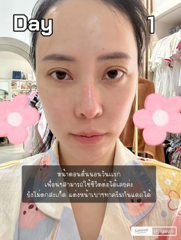 ขอบคุณคุณจูน @jirasuri มากนะครับที่ไว้วางใจให้หมอได้ดูแลปัญหาเรื่องรูขุมขนและจุดด่างดำด้วย โปรแกรม LaserME ครับผม