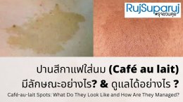 ปานสีน้ำตาล มีลักษณะอย่างไร & ดูแลได้อย่างไร?