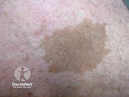 ปานสีน้ำตาล มีลักษณะอย่างไร & ดูแลได้อย่างไร?