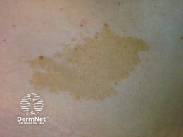 ปานสีน้ำตาล มีลักษณะอย่างไร & ดูแลได้อย่างไร?