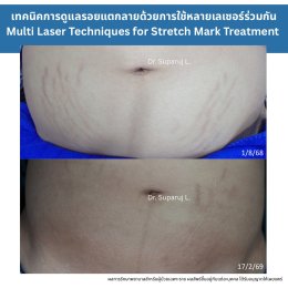 ทำไมต้องใช้เลเซอร์หลายชนิดในการรักษาหลุมสิว แผลเป็น รอยแตกลาย ?