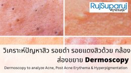 Dermatology Insights: วิเคราะห์ปัญหาสิว รอยดำ รอยแดงสิวด้วย กล้องส่องขยาย Dermoscopy to analyze Acne, Post Acne Erythema & Hyperpigmentation 