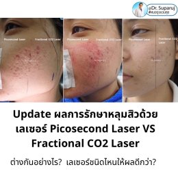 เจาะลึกความแตกต่าง: Fractional CO2 vs Fractional Picosecond Laser ในการรักษาหลุมสิว