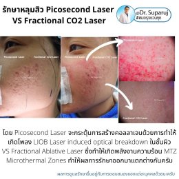 เจาะลึกความแตกต่าง: Fractional CO2 vs Fractional Picosecond Laser ในการรักษาหลุมสิว