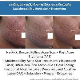 รักษาหลุมสิวแต่พักหน้าไม่ได้ มีวิธีอะไรบ้าง ?