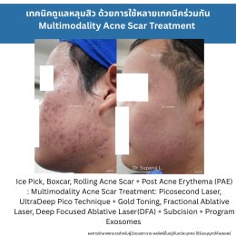 รักษาหลุมสิวแต่พักหน้าไม่ได้ มีวิธีอะไรบ้าง ?