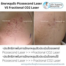 เจาะลึกความแตกต่าง: Fractional CO2 vs Fractional Picosecond Laser ในการรักษาหลุมสิว