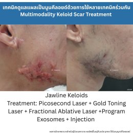 รักษาหลุมสิวแต่พักหน้าไม่ได้ มีวิธีอะไรบ้าง ?
