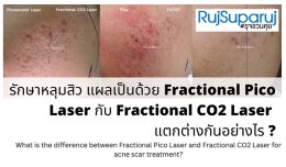 เจาะลึกความแตกต่าง: Fractional CO2 vs Fractional Picosecond Laser ในการรักษาหลุมสิว