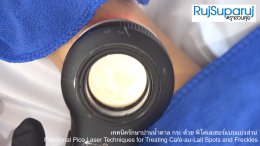 เทคนิครักษาปานน้ำตาล กระ ด้วย พิโค่เลเซอร์แบบแบ่งส่วน Fractional Pico Laser Techniques for Treating Café-au-Lait Spots and Freckles