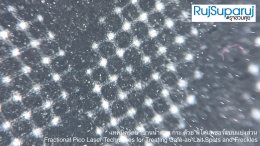 เทคนิครักษาปานน้ำตาล กระ ด้วย พิโค่เลเซอร์แบบแบ่งส่วน Fractional Pico Laser Techniques for Treating Café-au-Lait Spots and Freckles