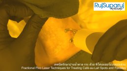 เทคนิครักษาปานน้ำตาล กระ ด้วย พิโค่เลเซอร์แบบแบ่งส่วน Fractional Pico Laser Techniques for Treating Café-au-Lait Spots and Freckles