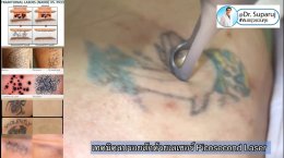 เทคนิคลบรอยสักด้วยเลเซอร์ Picosecond Laser