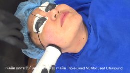 เทคนิค ยกกระชับใบหน้าและคิ้วด้วย เทคนิค Triple-Lined Multifocused Ultrasound
