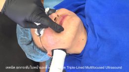 เทคนิค ยกกระชับใบหน้าและคิ้วด้วย เทคนิค Triple-Lined Multifocused Ultrasound