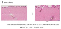 เทคนิค ยกกระชับใบหน้าและคิ้วด้วย เทคนิค Triple-Lined Multifocused Ultrasound