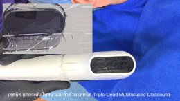เทคนิค ยกกระชับใบหน้าและคิ้วด้วย เทคนิค Triple-Lined Multifocused Ultrasound