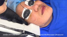เทคนิค ยกกระชับใบหน้าและคิ้วด้วย เทคนิค Triple-Lined Multifocused Ultrasound