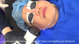 เทคนิค ยกกระชับใบหน้าและคิ้วด้วย เทคนิค Triple-Lined Multifocused Ultrasound