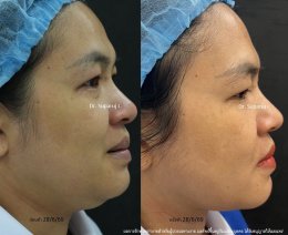 แนะนำโปรแกรมยกกระชับผิวด้วยเลเซอร์ หลายความยาวคลื่น Program Platinum Lifting Multi-Wavelength Laser