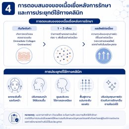 เทคนิคการยกกระชับใบหน้าและคิ้วด้วย Triple-Lined Multifocused Ultrasound: โปรแกรม X-Triple