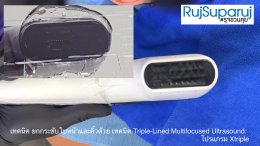 เทคนิคการยกกระชับใบหน้าและคิ้วด้วย Triple-Lined Multifocused Ultrasound: โปรแกรม X-Triple
