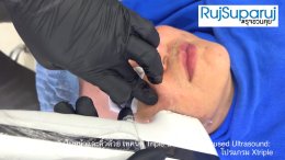 เทคนิคการยกกระชับใบหน้าและคิ้วด้วย Triple-Lined Multifocused Ultrasound: โปรแกรม X-Triple