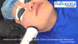 เทคนิคการยกกระชับใบหน้าและคิ้วด้วย Triple-Lined Multifocused Ultrasound: โปรแกรม X-Triple