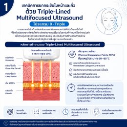 เทคนิคการยกกระชับใบหน้าและคิ้วด้วย Triple-Lined Multifocused Ultrasound: โปรแกรม X-Triple