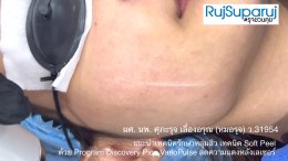 แนะนำเทคนิครักษาหลุมสิว เทคนิค Soft Peel ด้วย Program Discovery Pico VarioPulse ลดความแดงหลังเลเซอร์
