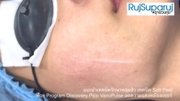 แนะนำเทคนิครักษาหลุมสิว เทคนิค Soft Peel ด้วย Program Discovery Pico VarioPulse ลดความแดงหลังเลเซอร์