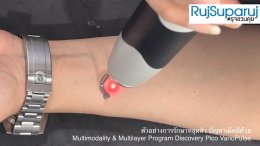ตัวอย่างการรักษาหลุมสิว ปัญหาเม็ดสีด้วย Multimodality & Multilayer Program Discovery Pico VarioPulse