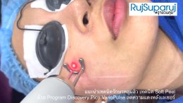 แนะนำเทคนิครักษาหลุมสิว เทคนิค Soft Peel ด้วย Program Discovery Pico VarioPulse ลดความแดงหลังเลเซอร์