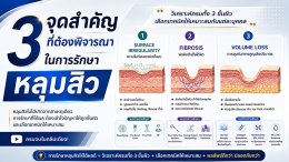 3 จุดสำคัญที่ต้องพิจารณาในการรักษาหลุมสิว: Surface Irregularity, Fibrosis และ Volume Loss