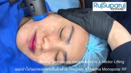 การดูแลความกระชับของผิวด้วย Program XTherma Monopolar RF