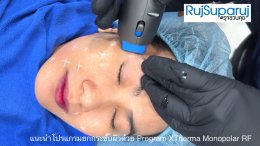 การดูแลความกระชับของผิวด้วย Program XTherma Monopolar RF